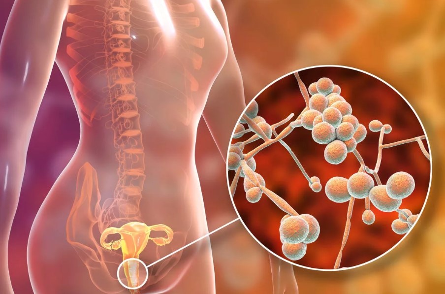 Vaginal Yeast Infection